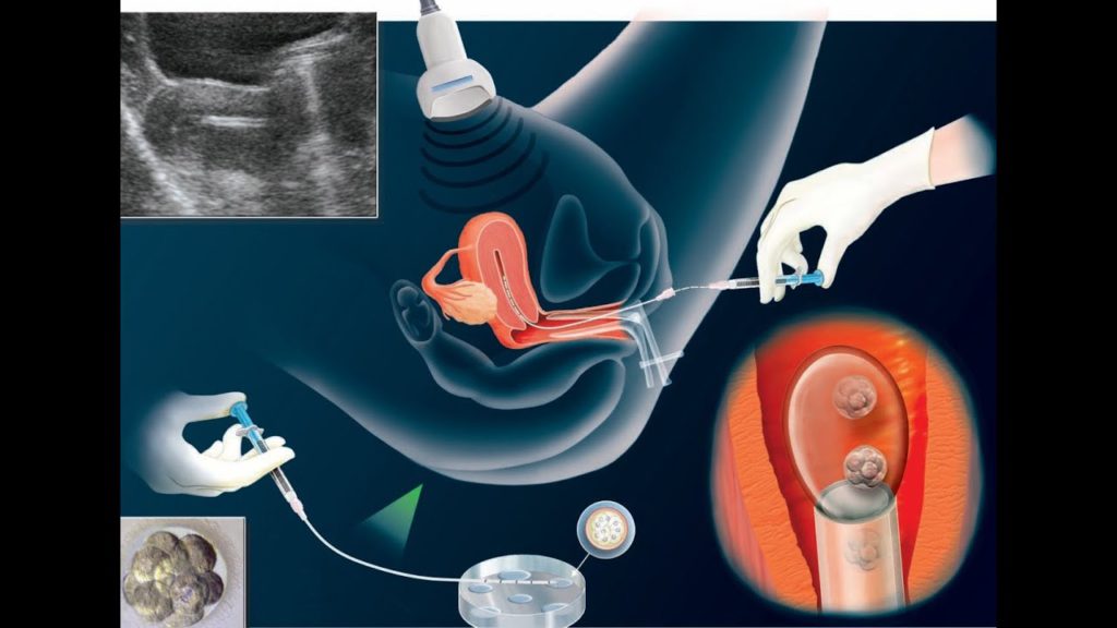 перенос-эмбриона-в-матку-основа-эко